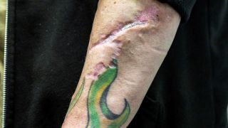 Das Bild zeigt einen Ausschnitt eines tätowierten Arms mit Wunden, die durch die Droge Tranq verursacht werden.